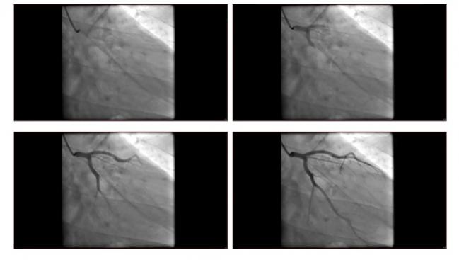 TWENTE: Resolute and Xience Stents Show Comparable Outcomes Up to 5 Years