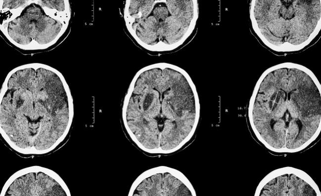 Hold the tPA? Study Probes Necessity of IV Thrombolysis Prior to Endovascular Therapy for Acute Stroke