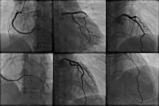 Aspirate Contrast to Limit Acute Kidney Injury in Select Coronary Angiography Cases? Maybe, Maybe Not