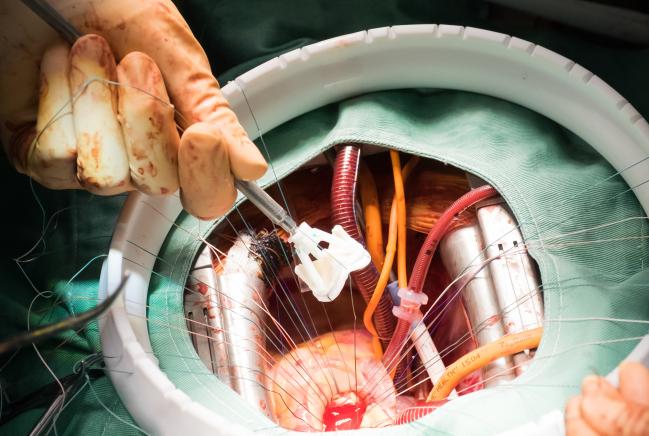 Prosthesis-Patient Mismatch After Aortic Valve Replacement Declining but Tied to Poorer Survival