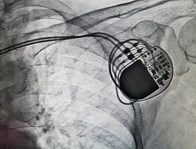 The Prickly Problem of Permanent Pacing After TAVR: One Hospital Pitches a Protocol
