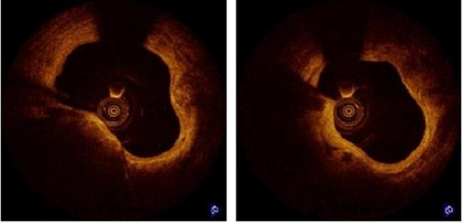 DESolve Bioresorbable Stent Compares Well With Absorb but Longer Follow-up Needed