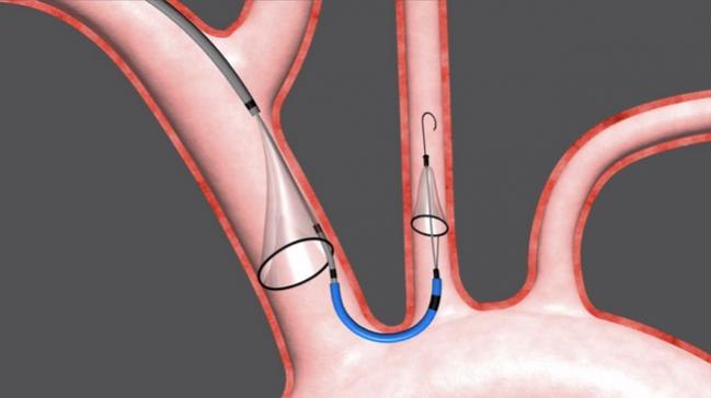 FDA Advisors Positive on Sentinel Cerebral Protection Device in TAVR 