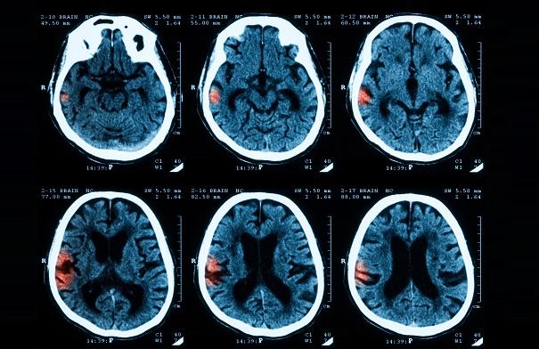 Restarting Oral Anticoagulation After Intracerebral Hemorrhage Tied to Better Outcomes