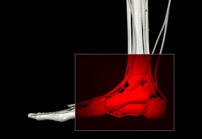 Routine Screening of ABI to Identify PAD: Despite Guidelines, One Expert Asks Why Not?