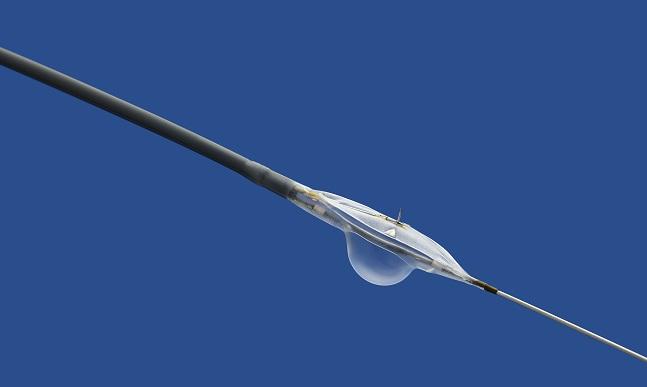 Targeted Delivery of Dexamethasone Combats Restenosis in Femoropopliteal Lesions: DANCE Trial