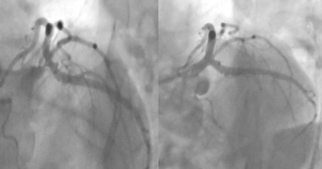 Rate of Incomplete Revascularization During PCI Is Highly Variable Across Operators