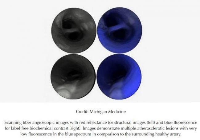 New Laser-Based Imaging Modality in Development for Atherosclerosis Assessment