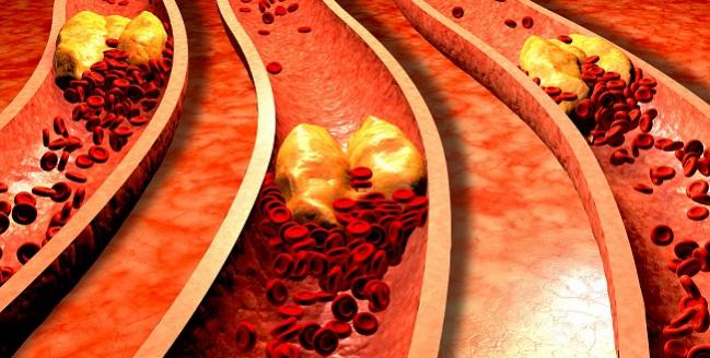 Underappreciated by Clinicians, Critical Limb Ischemia Has Dire Fallout for Patients 