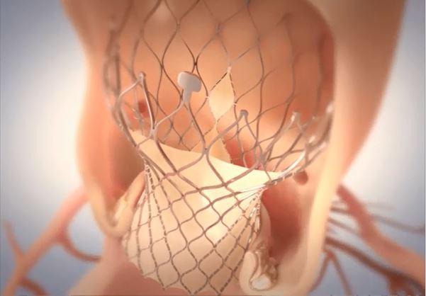 Early Clinical Outcomes With Evolut R Reassure, Suggest Improvements Over First-Gen CoreValve 