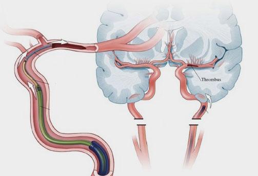 Does It Matter How Clot is Removed in Acute Ischemic Stroke? Maybe Not