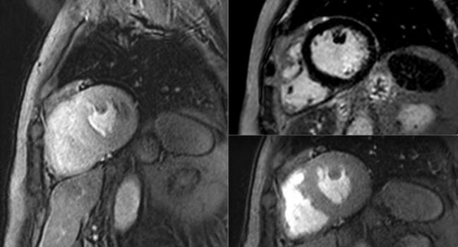 CMR Perfusion Imaging Holds Its Own Against Invasive Approach to Managing Stable Angina