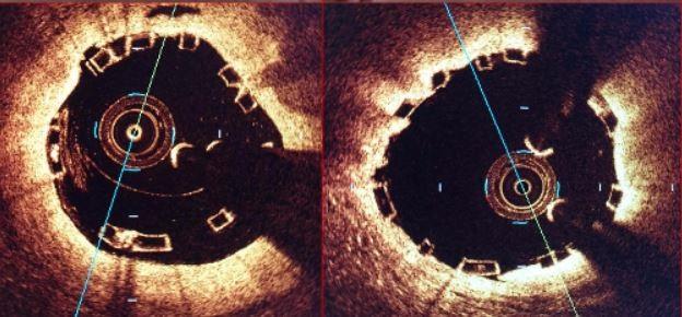 Scaffold Thrombosis Concerns With Absorb BVS Echoed in AIDA Trial