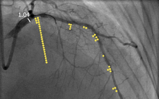 To Stent or Not to Stent? iFR vs FFR Late Breakers at ACC 2017 Seek to Shake Up Treatment Decisions