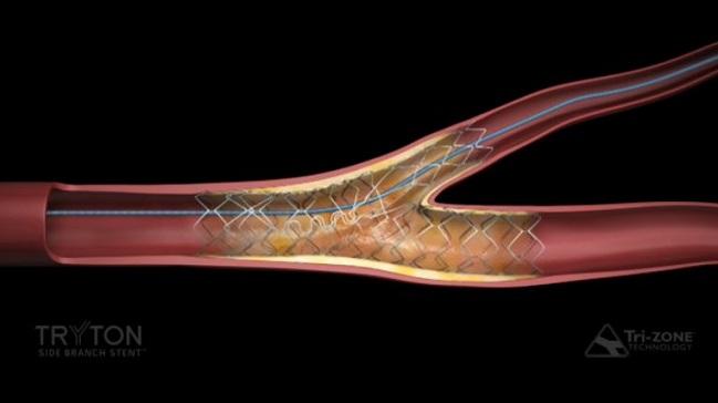 FDA Gives Thumbs Up to Side Branch Stent for Bifurcation Lesions