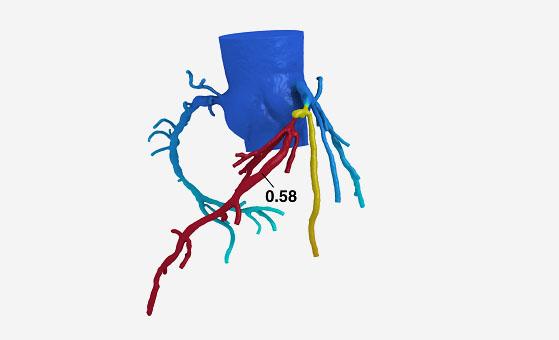 PROMISE Analysis Boosts Gatekeeper Role for FFRCT in Symptomatic Stable CAD