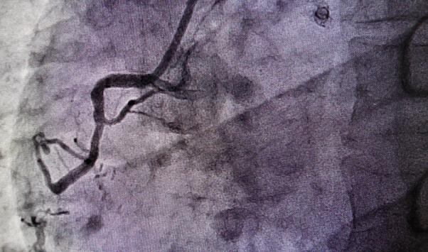 Benefits of FFR-Guided Complete Revascularization in STEMI May Be Limited to Most Severe Disease
