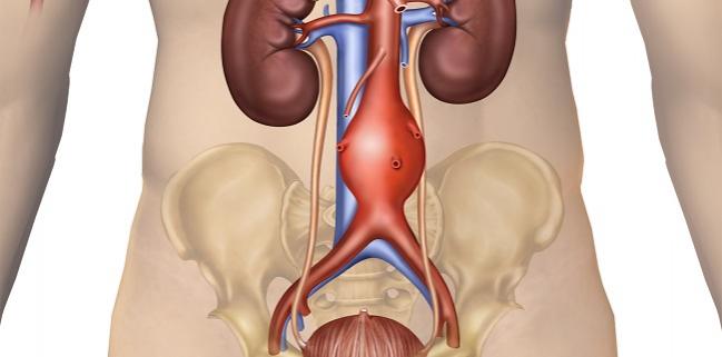 Even With EVAR, Women With AAA Face Starkly Different Survival Than Men