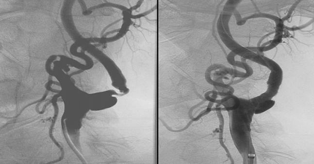 Plaque Protrusion an Infrequent but Troubling Complication of Carotid Artery Stenting