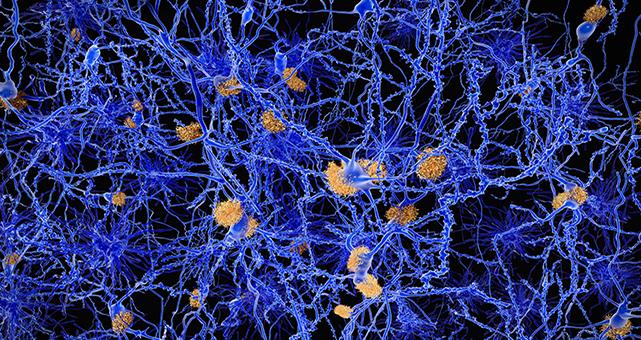 Midlife Vascular Risk Factors Linked to Amyloid Plaques in Alzheimer’s