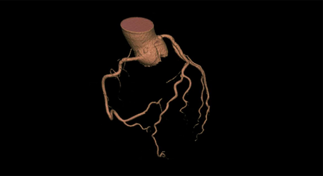 Using Coronary CTA to Evaluate Suspected CAD May Improve Patient Outcomes
