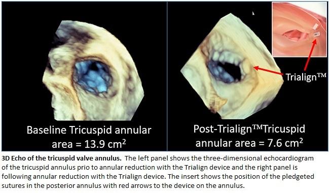 SCOUTing the ‘Forgotten Valve’: Promise for a New Percutaneous Treatment Option in Tricuspid Regurgitation