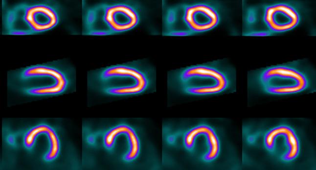 Very Low Radiation Doses With SPECT MPI Are Possible