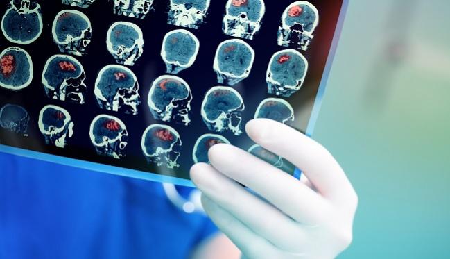 Two New Trials Buoy Outlook for PFO Closure in Patients With Cryptogenic Stroke