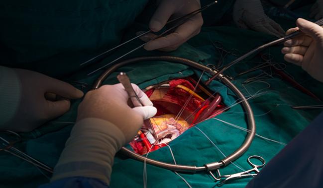 High-Volume Surgeons More Likely to Perform Durable Mitral Valve Repairs, Have Better Outcomes