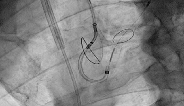 Embolic Protection During TAVR Reduces Stroke Risk, Single-Center Study Shows
