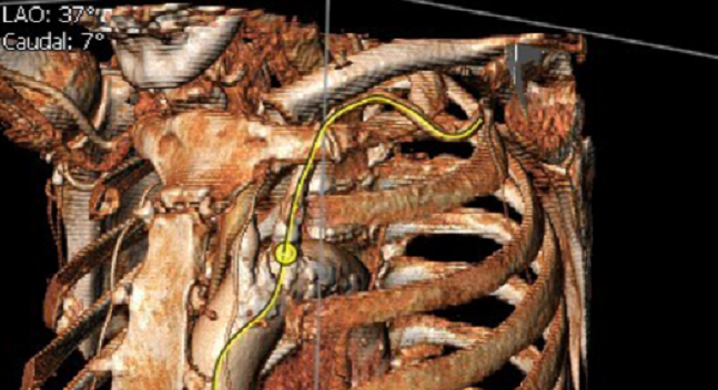 Seeing Is Believing: Experts Predict an Expanded Role for Cardiac CT in Structural Interventions