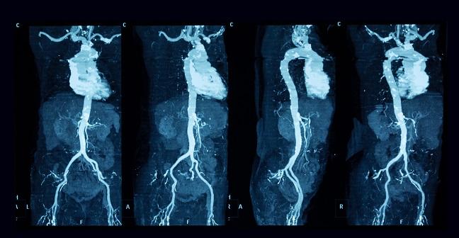 Incidental Findings on CT Angiography Predict All-Cause Mortality Following TAVR
