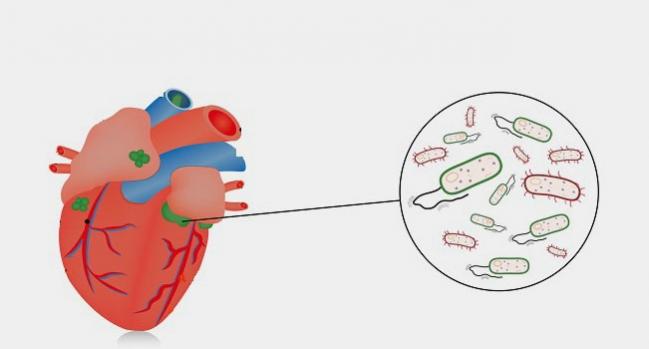 Infective Endocarditis Guidelines: The More the Merrier? Maybe Not