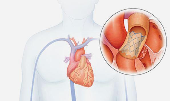 Stent Fracture, Reintervention Lessened With Prestenting Before Melody Pulmonary Valve Implantation