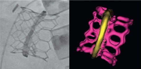 After Failed Mitral Valve Surgery, Transcatheter Valve-in-Valve or Valve-in-Ring Shows Promise in High-Risk Patients