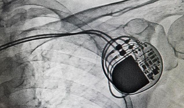 One in Four ICD Patients Need Reintervention Within 5 Years