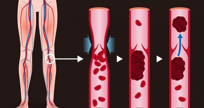 Apixaban May Be Better Choice Than Rivaroxaban for DVT Patients