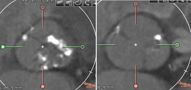 CT Scans Before and After TAVR Show Tricuspid, Bicuspid Valves Are Reassuringly Similar