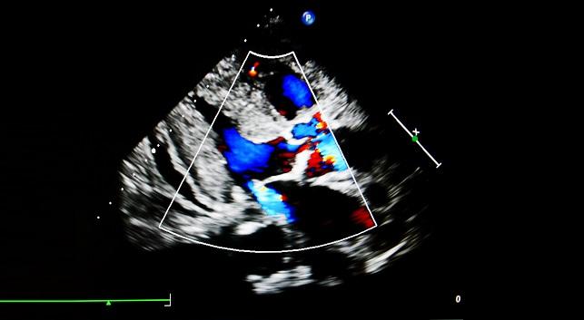 As Percutaneous Mitral Valve Techniques Advance, Questions Turn to Combinations, Staging