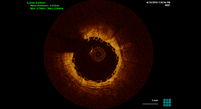 Absorb BVS Again Linked to Scaffold Thrombosis at 1 Year and Beyond