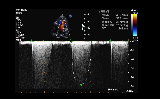 High Blood Pressure May Raise Mitral Regurgitation Risk