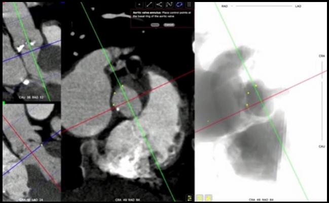 Long-term Evidence Supports Better Survival for Women Than Men After TAVR