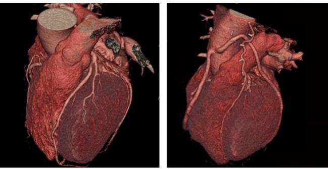 CTA Reduces MI Compared With Functional Stress Testing, but at a Cost