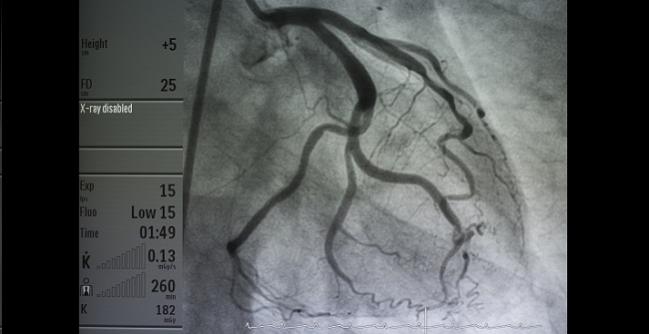 Angiography, Revascularization Safe in Acute MI Patients Taking OACs for Atrial Fibrillation