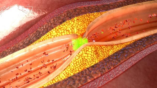 Radial Access Best for PCI Following Thrombolysis in STEMI