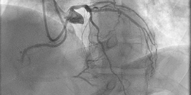 Patients Commonly Get High Radiation Doses During CTO PCI