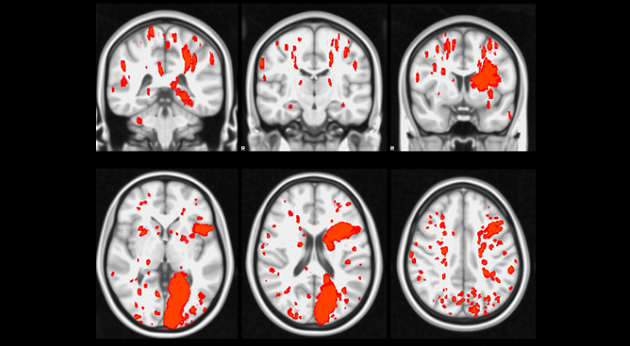 Experts Debate: Should Cerebral Protection Be Used for All TAVRs?