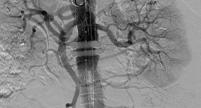 EVAR Shown to IMPROVE Outcomes Over Surgery for Ruptured AAA Patients