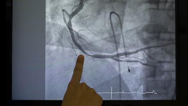 RECAP: In the Cath Lab, a Lead-free Pad Placed on the Patient Cuts Operator Radiation Exposure