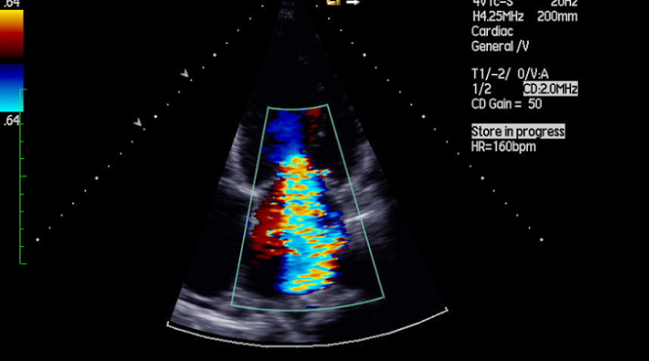 Transcatheter MV Repair Shows Continued Efficacy, Safety at 6 Months